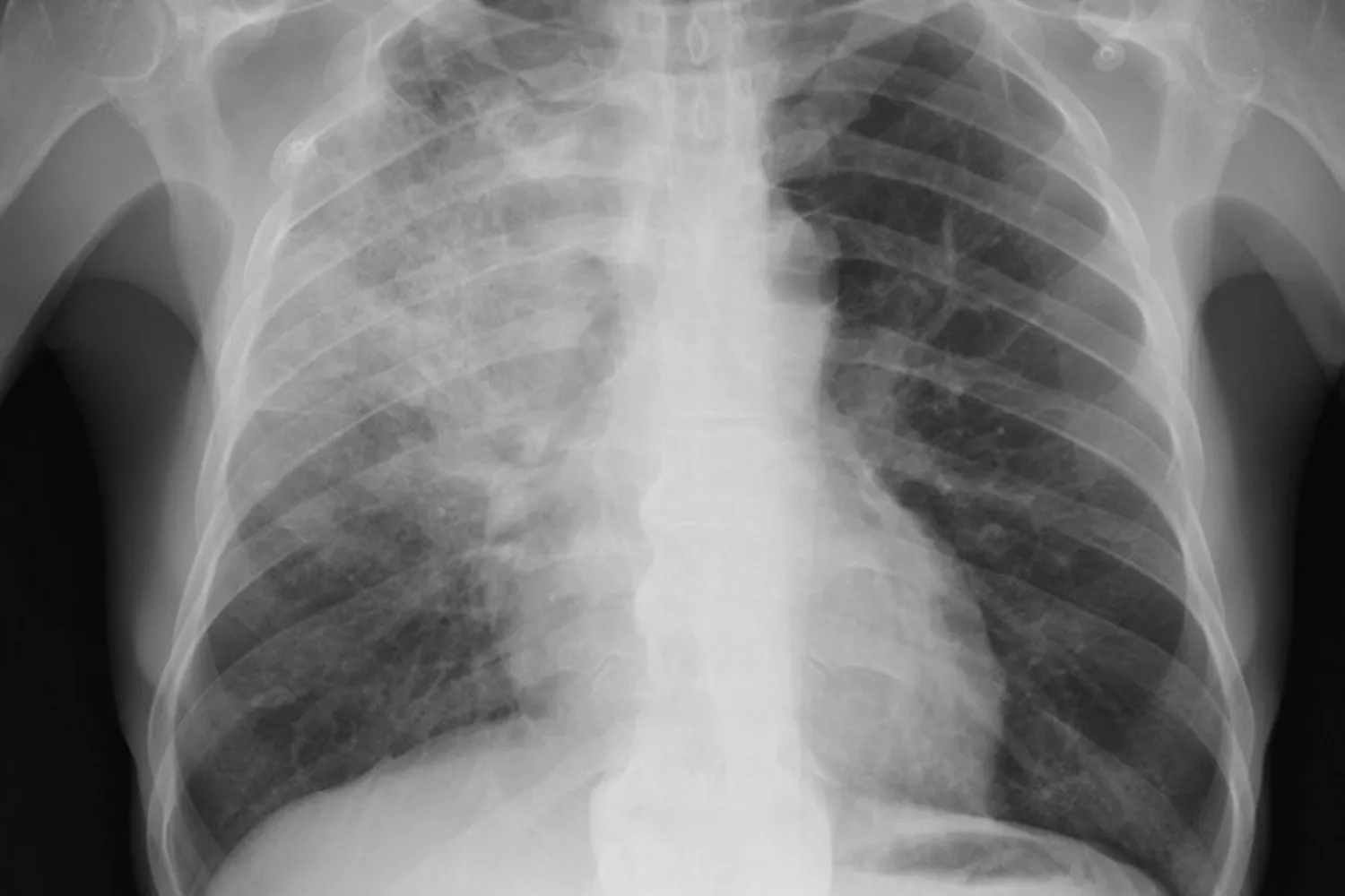 Una radiografía de los pulmones con neumonía   FLICKR