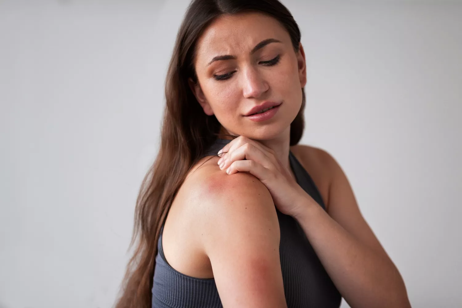 Una mujer que ha sufrido picaduras de mosquito / FREEPIK