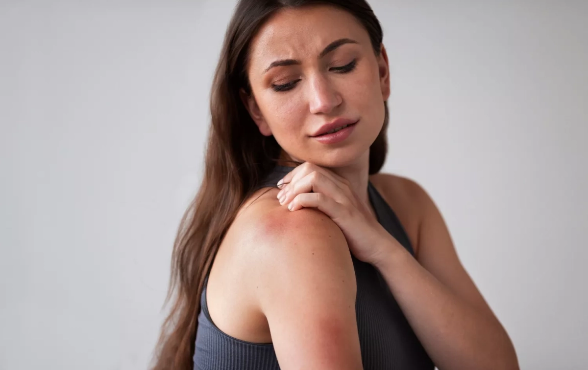 Una mujer que ha sufrido picaduras de mosquito / FREEPIK