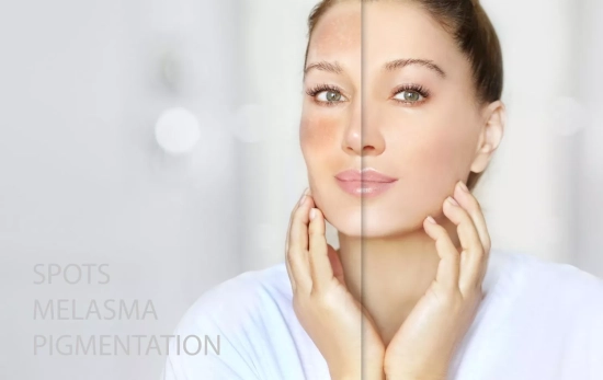 Una chica con manchas de melasma por el sol/ CANVA Una chica con manchas de melasma por el sol/ CANVA