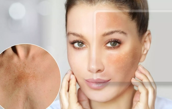 Una chica con manchas solares en el rostro/ Montaje CONSUMIDOR GLOBAL Una chica con manchas solares en el rostro/ Montaje CONSUMIDOR GLOBAL